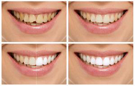Smile Makeover provided by Raj Talwar DDS in Lafayette, CA