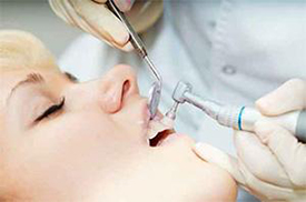 Teeth Cleaning provided by Raj Talwar DDS in Lafayette, CA