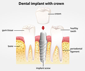 Dental Crowns provided by Raj Talwar DDS in Lafayette, CA
