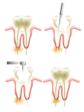 Root Canals provided by Raj Talwar DDS in Lafayette, CA