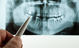 Dental X-rayprovided by Raj Talwar DDS in Lafayette, CA